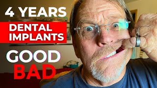 My Review of Full Dental Implants After 4 Years [upl. by Mari244]