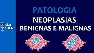 Neoplasias Benignas e Malignas  Características Nomenclatura e Diferenciação Patologia Geral [upl. by Aikrahs]