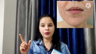 Faceclin gel review 😘😘 [upl. by Luhem]