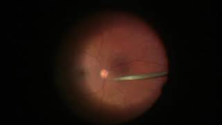 Endolaser Panretinal Photocoagulation PRP [upl. by Sivrat]