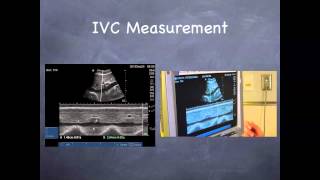 Tutorial Aorta amp IVC [upl. by At117]