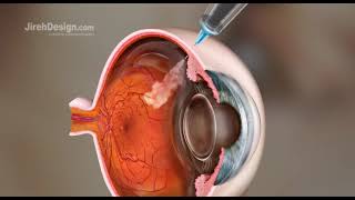 Intravitreal Injection Animation HD [upl. by Polky]