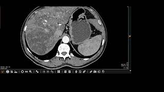 Hepatic manifestations of OslerWeberRendu Syndrome [upl. by Rudolph]