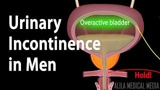 Urinary Incontinence in Men Animation [upl. by Fariss]