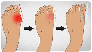 How to Fix Bunions in 5 Steps [upl. by Wolf568]