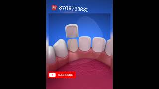 Dental Veneers Laminates for Bollywood Smile yt shorts dentalveneerssmile dentist in Patna [upl. by Beora]