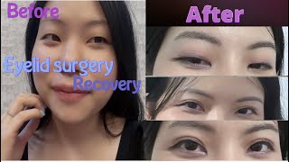 My upper eyelid surgery recovery Blepharoplasty [upl. by Humbert]