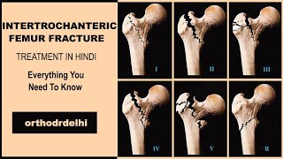 INTERTROCHANTRIC FRACTURE FEMUR IN HINDI proximal femur fractures IN HINDI [upl. by Lani]