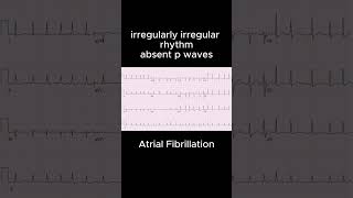 Atrial FibrillationCardiology ECG PMDC NLE NRE PLAB USMLE ecg ecgbasics education ecgtutorial [upl. by Cerys]