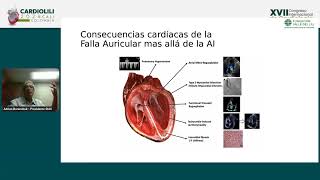 Atriopatía y fibrilación auricular  Adrián Baranchuk [upl. by Hong]