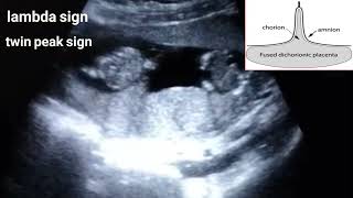 Dichorionic diamniotic twin pregnancylambda sign [upl. by Rosalind628]