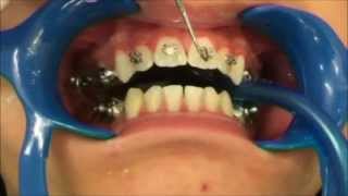 Presenting the Herbst appliance Part 3 Athanasios Tom Nasiopoulos Specialist Orthodontist [upl. by Olwena]