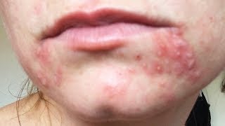 Dealing with Recurring Perioral Dermatitis [upl. by Whalen]