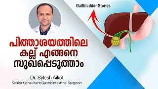 പിത്താശയക്കല്ലുകള്‍ ഒഴിവാക്കാം  Gallbladder Stone Treatment Malayalam Health Tips [upl. by Aloz]