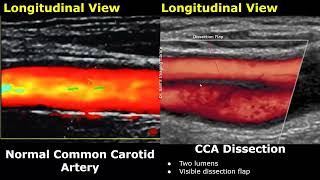 Carotid Artery ColorSpectral Doppler Ultrasound Normal Vs Abnormal Images  ICA Stenosis USG [upl. by Willis]