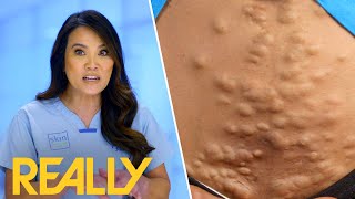 Dr Lee Removes 62 Cyst Bumps From Steatocystomas Patient l Dr Pimple Popper [upl. by Eemyaj]