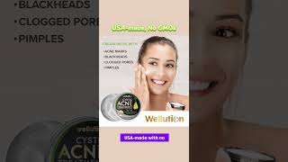 Wellution Cystic Acne Treatment face Cream howtolightendarkspots antiaging [upl. by Aernda]