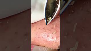 Skincare  Blackheads Removal 275 tweezers skincare blackheads blackheads [upl. by Ihtak561]