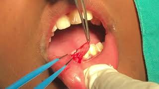 Mucous Cyst lip [upl. by Nyllij640]