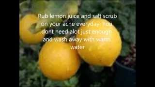 Home Remedies to Acne  The fastest way to treat your acne from home [upl. by Aubree354]