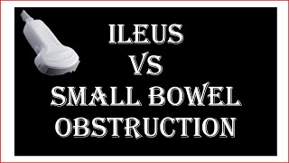 Ultrasound of ileus VS small bowel obstruction [upl. by Romeyn]