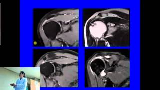 Resonancia Magnética Nuclear en Hombro [upl. by Morissa203]