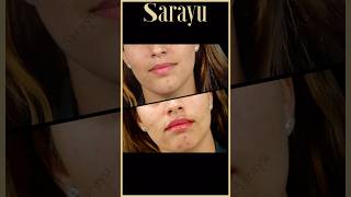 Achieve Perfectly Balanced Lips with Lip Fillers  Sarayu Clinics fillers [upl. by Mongeau]