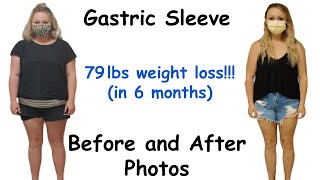 Gastric Sleeve Before and After Pictures and Results part 3  Bariatric Weight Loss Journey [upl. by Handal]