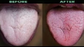 Easy amp Natural Way To Get Rid Of Tongue Thrush In 2 Minutes Using Baking Soda [upl. by Nilac]