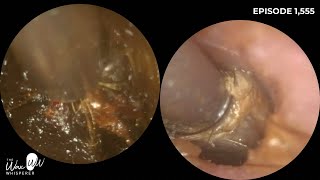 1555  2 Ear Wax Removals from Narrow amp Hairy Ear Canals [upl. by Monjo47]