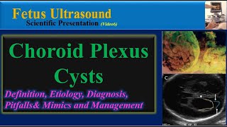 Fetus Ultrasound Choroid Plexus Cyst [upl. by Letitia222]