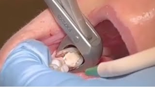 Extraction of Lower second Molar [upl. by Lednyc]