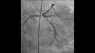 Left main PCI for distal lesion with caliber mismatch [upl. by Dysart347]