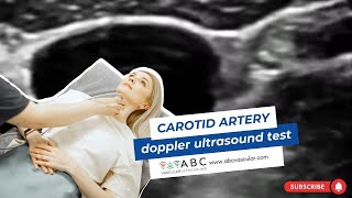 Carotid artery Doppler ultrasound test Accurate examination to perform a basic ultrasound carotid [upl. by Ylreveb]