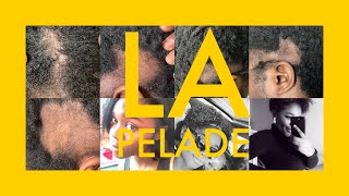 STORY TIME  LA PELADE DE L’ENFER  la solution miracle contre la pelade  Solution against ALOPECIA [upl. by Aratehs665]