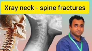 cervical spine fractures radiology  part 2 [upl. by Homer]