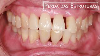 Doença periodontal [upl. by Eniamrahc]