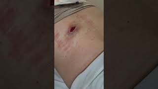 Cisto infectado que estourou Infected cyst that burst [upl. by Marillin]