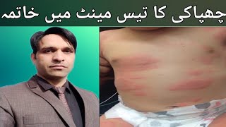 Urticaria homeopathic treatment  Urdu Hindi  چھپاکی کا ہومیو پیتھک علاجbesttreatment urticaria [upl. by Kessler511]