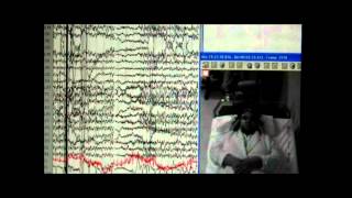 Nonepileptic seizures with levetiracetam therapy  Supplementary video 60089 [upl. by Marlee]