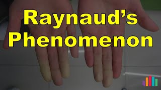 Raynauds Phenomenon [upl. by Eilyak67]