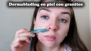 Dermablading  Depilación de cara en piel con acné o granitos [upl. by Evey]