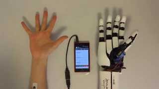 handiii accessible myoelectric hand prosthesis [upl. by Eiznikcm]