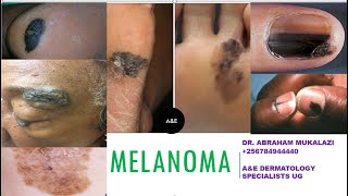 UPDATES ON MELANOMA BY DR ABRAHAM SKINCANCER education dermatology [upl. by Lledyl]