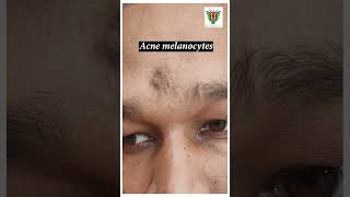 Melanocytes Acne Removal by laser  DrSanjeeb Rout [upl. by Daniala152]