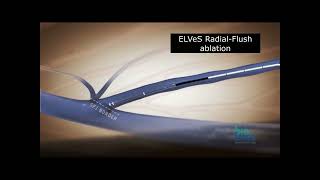 ELVeS RadialFlush ablation [upl. by Anivram407]