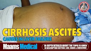 Ascites Fluid Buildup Causes Symptoms and Treatment  Maams [upl. by Kimmi308]