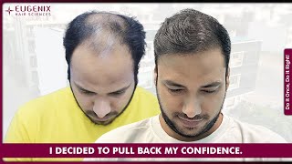 Hair Transplant Results  Best Cost amp Best Hair Transplant Result [upl. by Ellak696]