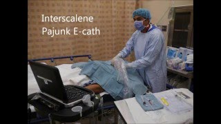 USG Interscalene Catheter Insertion Pajunk Ecath  OutOfPlane Technique [upl. by Patrice964]