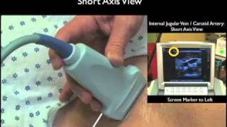 How To Ultrasound Guidance for Central Venous Access Part 1 Case Study [upl. by Arutak]